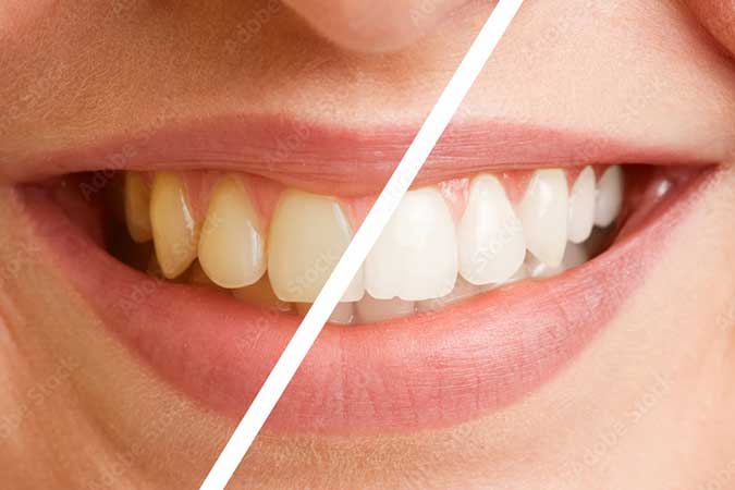 zahnarztliche-leistungen-bleaching