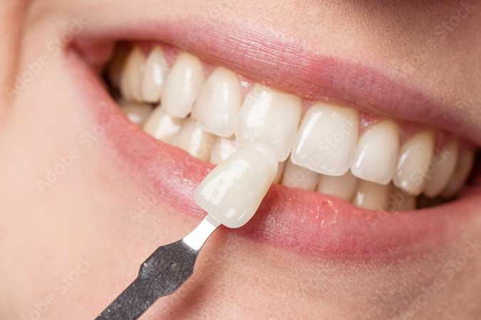 zahnarztliche-leistungen-veneers